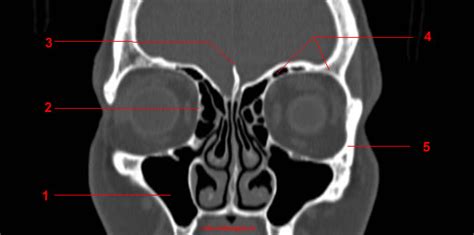 Ct Of The Orbit Anatomy W Radiology