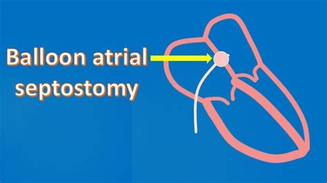 Balloon Atrial Septostomy All About Cardiovascular System And Disorders