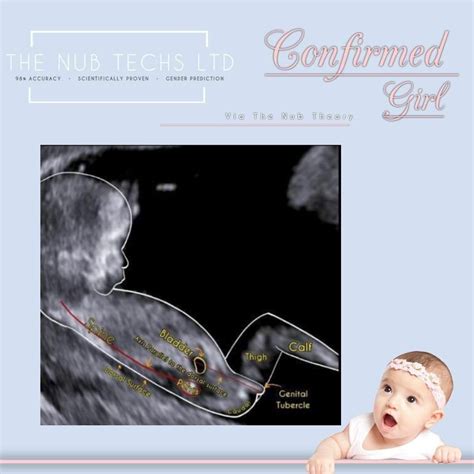 ultrasound nub theory uk  nub techs artofit
