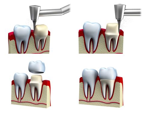 Dental Crowns Needs And Material Used Monash Dental Group