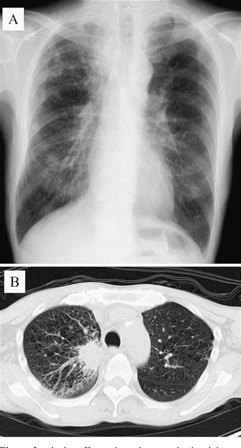 Figure 1 From A Case Of Pulmonary Adenocarcinoma With Penile Metastasis Semantic Scholar