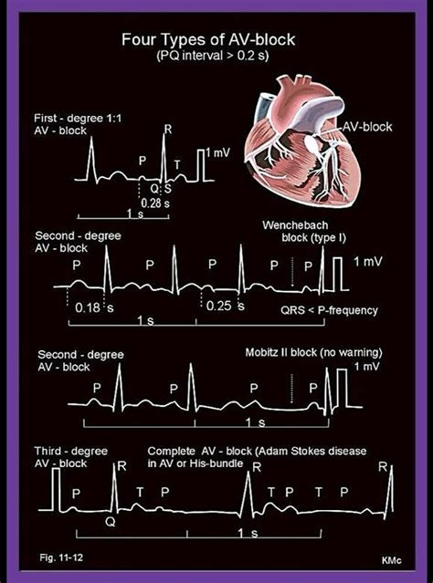 ECG Heart Block Rhythms - Four types of atrio-ventricular (AV)-block ...