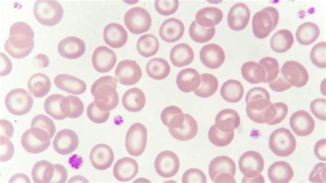 Curso De Hematologia Laboratorial Enfoque Em Citologia Hematol Gica