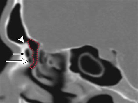 Failed Endoscopic Sinus Surgery Spectrum Of Ct Findings In The Frontal