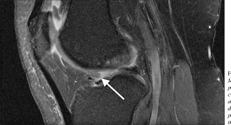 Structure Of Deep Infrapatellar Bursa Semantic Scholar