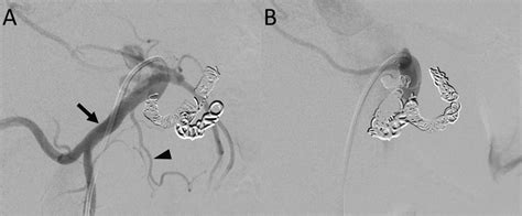 -Angiography of the celiac artery during embolization of the celiac ...