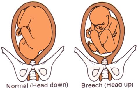 Pharmacy..: BreecH BaBy!!!!!