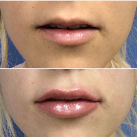 Lip Injections Before After Chicago Aesthetics Medspa