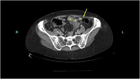 Polypoid Endometriosis Mimicking Peritoneal Carcinomatosis In A