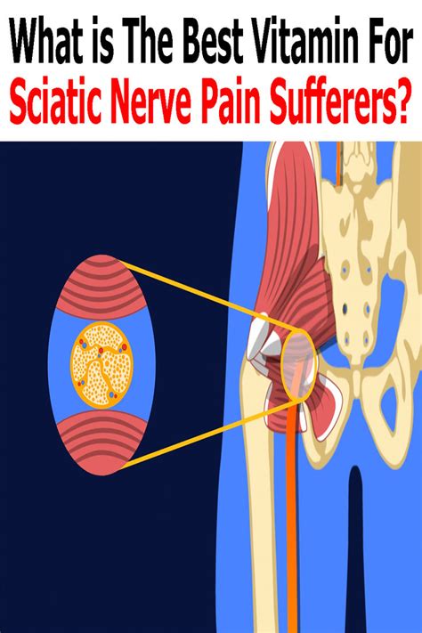 What Is The Best Vitamin For Sciatic Nerve Pain Sciatic Nerve