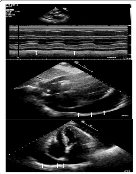 Transthoracic Echocardiogram M Mode Subcostal Four Chamber And Apical