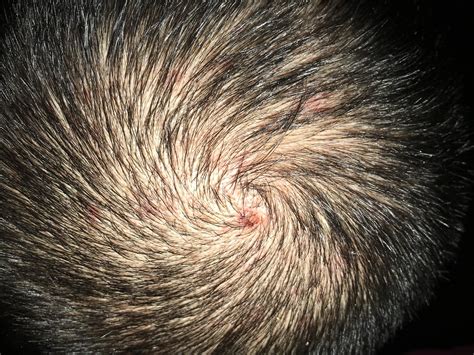 Is this Folliculitis? | Scrolller