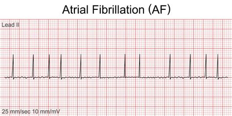 Atrial Fibrillation - Capital Heart Centre