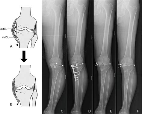 Images Of A Patient Who Underwent Arthroscopic Resection Of Osteophytes