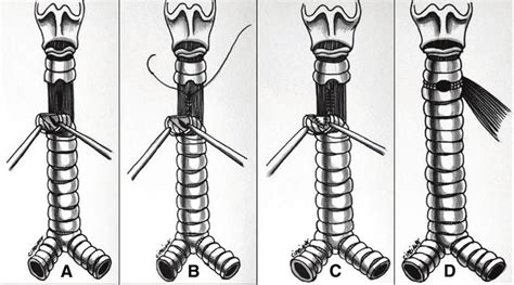 Surgical Procedure Drawing A Transverse Tracheal Incision And