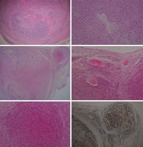 Figure3 Histological Findings Of The Left Temporal Nodule A F A B