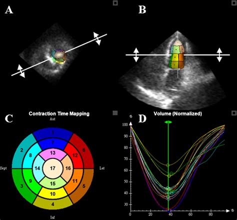 Normal Reference Ranges For Transthoracic Echocardiography Following