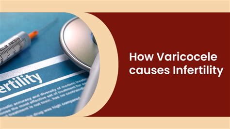 Varicocele Causes