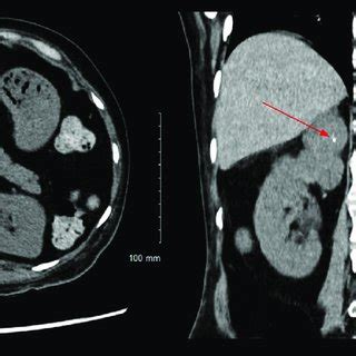 Computed Tomography CT Abdomen With Adrenal Protocol Showing A