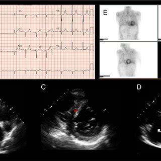 Positive Patient A Electrocardiogram Showing Atrial Fibrillation