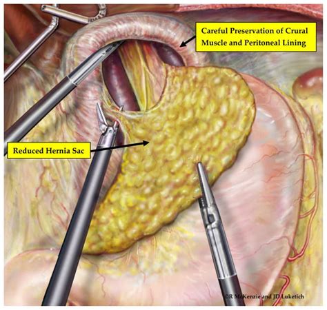 The Laparoscopic Approach To Paraesophageal Hernia Repair Abstract