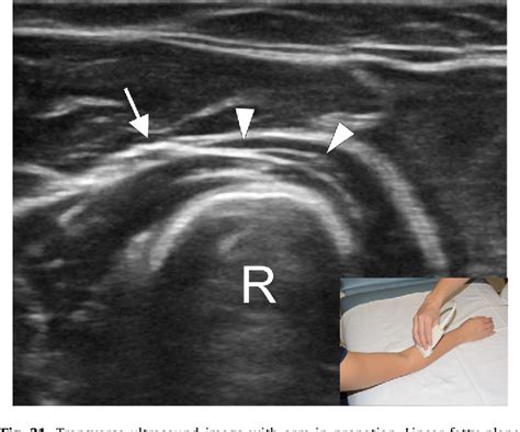 Figure 31 From Ultrasound Of The Elbow With Emphasis On Detailed