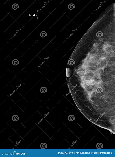 X Ray Digital Mammogram Or Mammography Of Both Side Breast Showing