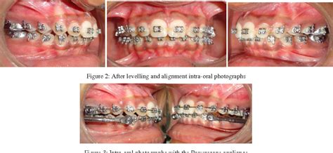 Correction Of Class Ii Using Powerscope Appliance A Case Report Semantic Scholar