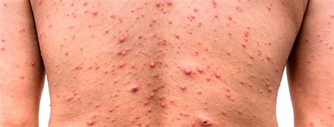 Difference Between Hiv Rash And Allergy Rash - Infoupdate.org