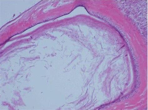 Histopathological examination demonstrating Nabothian cyst and... | Download Scientific Diagram