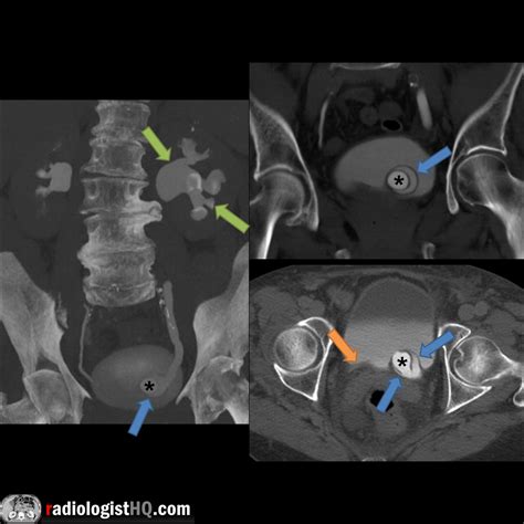 Ureterocele with obstructing stone on CT urogram : Radiology