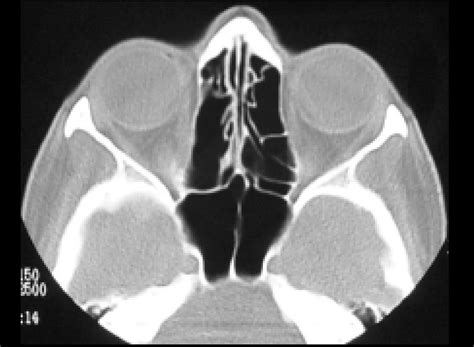 Tomografia Computadorizada De Seios Da Face Aspecto P S Operatorio