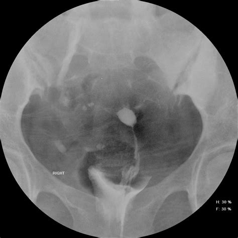 Venous Intravasation During Hysterosalpingography Image Radiopaedia Org