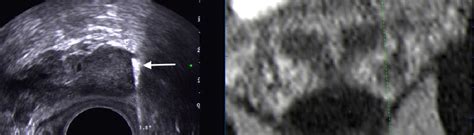 Figure 2 From Targeted MRI TRUS Fusion Guided Biopsy In Men With