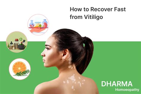 How To Recover Fast From Vitiligo Dr Shubham Tiwary