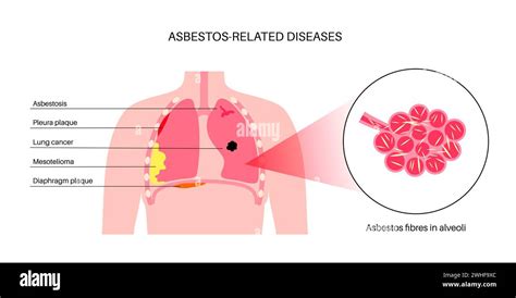 Asbestos Related Diseases Illustration Stock Photo Alamy