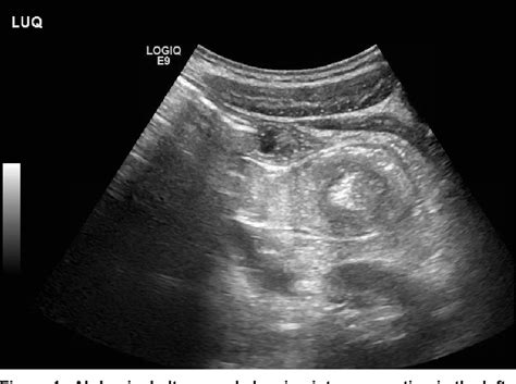 Figure 1 From Transient Jejunojejunal Intussusception In An Adolescent