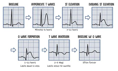 Stemi And Nstemi A Nurses Comprehensive Guide Health And Willness