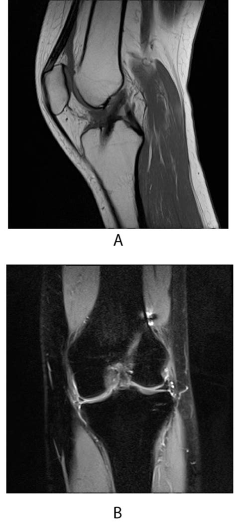 Migration Of A Meniscal Repair Implant Mimicking Meniscal Injury