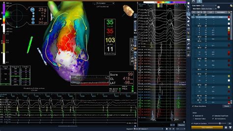 Advisor Hd Grid Mapping Catheter Se Case Library Abbott