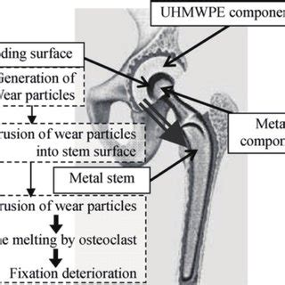 Application Of UHMWPE In A Artificial Hip Joints And B Knee Joints