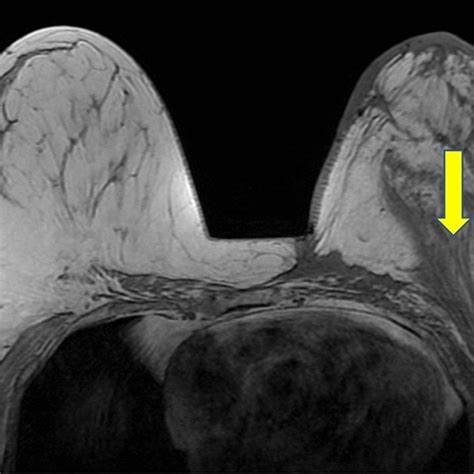 Year Old Female With Multifocal Left Breast Invasive Ductal