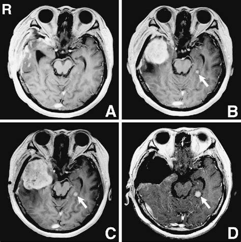 Figure From Anaplastic Meningioma With Extremely Rapid Recurrence