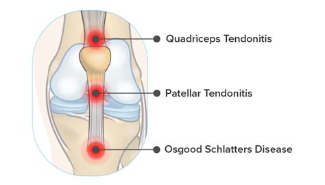 Quadriceps Tendon Pain Symptoms