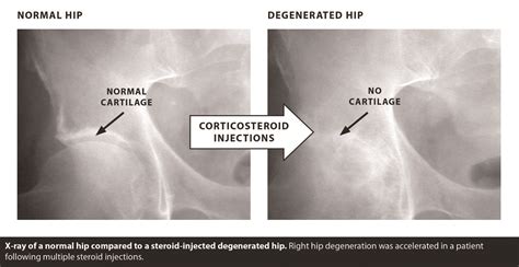 Treatment Options For Osteoarthritis Of The Hip • Southwest Florida S Health And Wellness Magazine