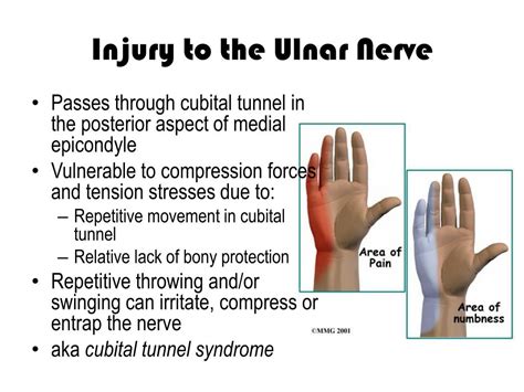 Ulnar Nerve Injury Symptoms