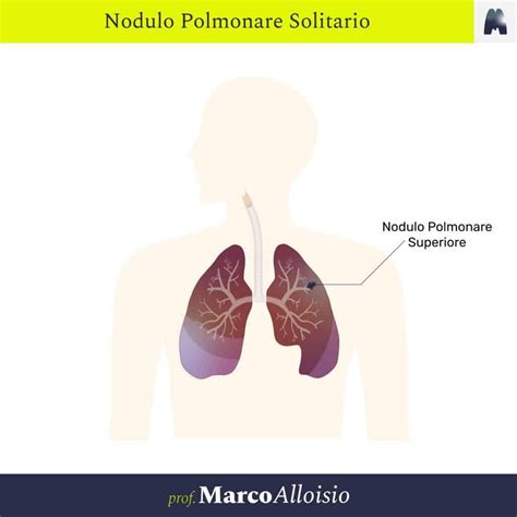 Neoplasie Polmonari Benigne Prof Marco Alloisio