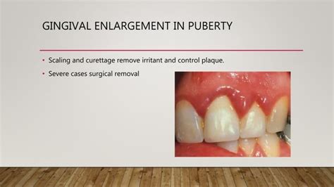 Treatment Of Gingival Enlargement Ppt