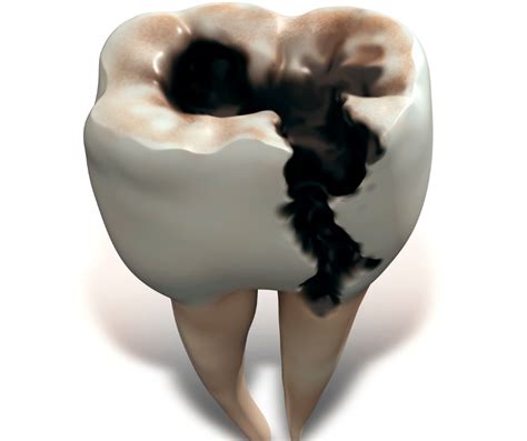 Dentalcora y la prevención del Cáncer Oral