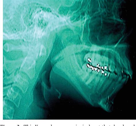 Figure 1 from Management and avoidance of complications in chin ...